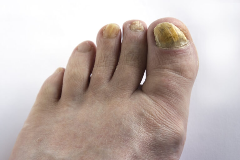 Toenail Fungus Testing: Why Accurate Diagnosis Matters Before Treatment