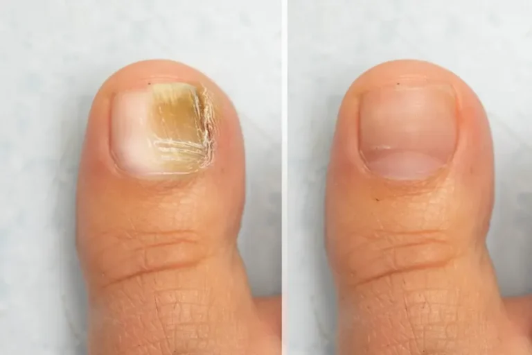 Laser Away That Yellow Toenail Fungus Before Summer