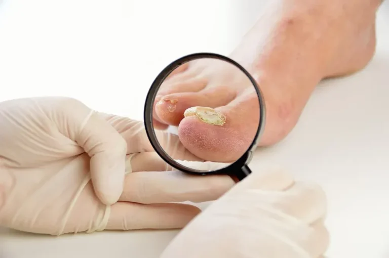 Will My Toenail Fungus Go Away on Its Own?