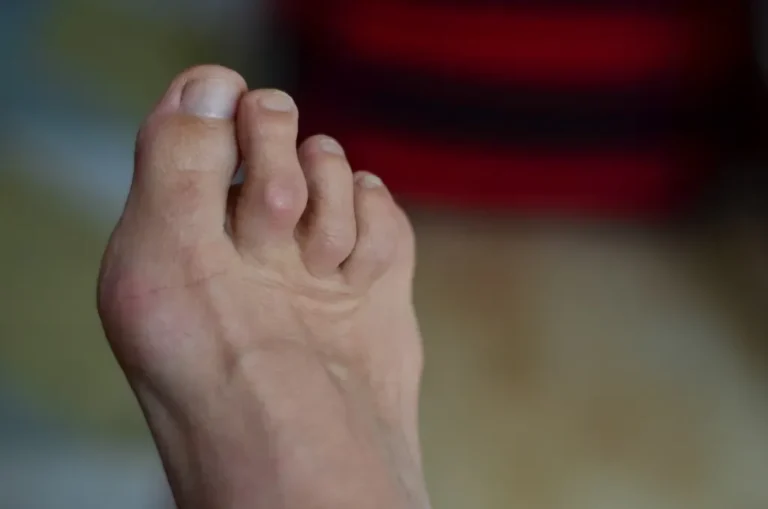 My Hammertoe Makes Wearing Shoes Painful: Can You Help?