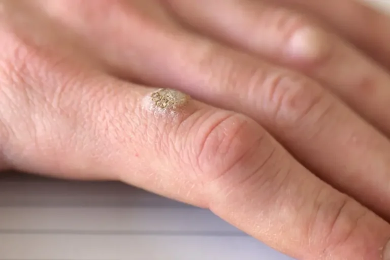 This Is the Virus that Causes Warts