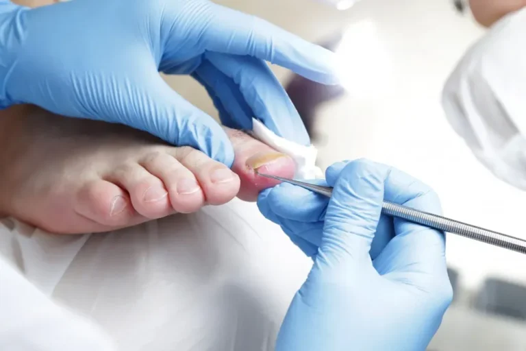 Stop Ignoring Your Ingrown Toenail