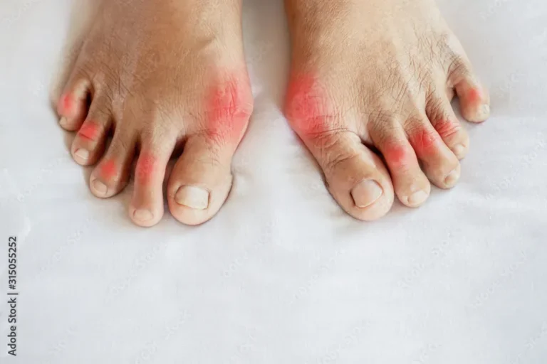 Home Remedies for Gout