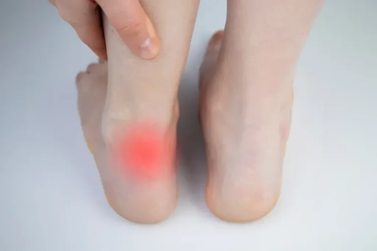 How to Reduce Your Achilles Tendon Pain