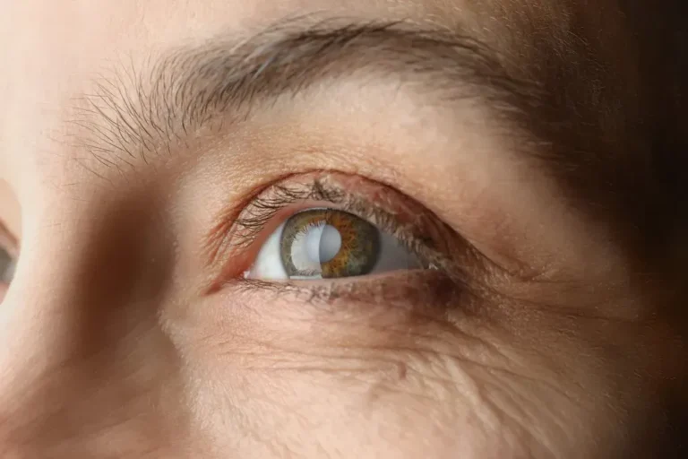 Cataracts and Glaucoma: What’s the Difference?