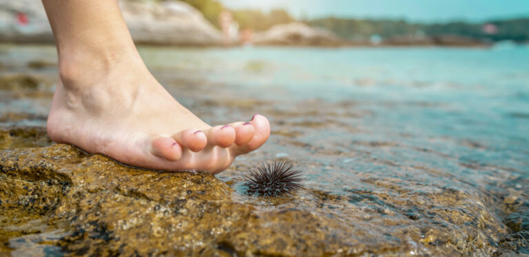 Beach Injuries: Common Summer Foot Problems You Shouldn’t Ignore